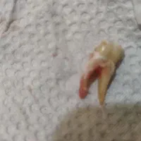 کشیدن دندان های خوی و سلماس|خدمات آرایشگری و زیبایی|خوی, |دیوار