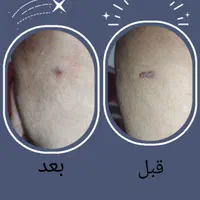 لیزر موهای زائدسوپرانو تیتانیوم وخالبرداری|خدمات آرایشگری و زیبایی|صدرا-فارس, فاز ۱|دیوار