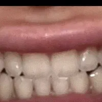 کامپوزیت دندان فکی ۸تومن|خدمات آرایشگری و زیبایی|تهران, والفجر|دیوار