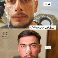 بوتاکس و ژل(فیلر)،بدون درد با ماندگاری بالا|خدمات آرایشگری و زیبایی|ارومیه, |دیوار