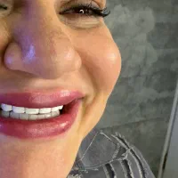 دندانپزشکی کامپوزیت با تخفیفِ ویژه از۱/۲۰۰تومان|خدمات زیبایی و سلامت|تهران, سازمان برنامه شمالی|دیوار