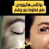 بوتاکس طبیعی درهرسنی|خدمات آرایشگری و زیبایی|رشت, بلوار گیلان|دیوار