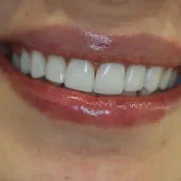 جشنواره دندانپزشکی از دم قسط عصبکشی روکش