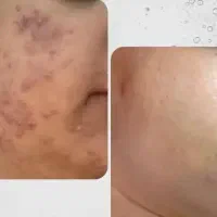 ده سال جوانتر شوید ،بایولیفت راه حل شما