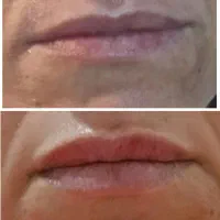 مزوتراپی مو ،ژل،بوتاکس|خدمات زیبایی و سلامت|تهران, بلوار کشاورز|دیوار