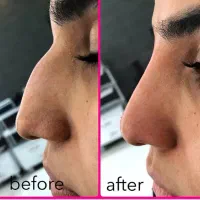 فیلر و آنزیم بینی|خدمات زیبایی و سلامت|تهران, پاسداران|دیوار