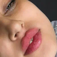 ساکشن غبغب، تزریق چربی، ژل و بوتاکس