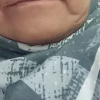 برداشتن خال