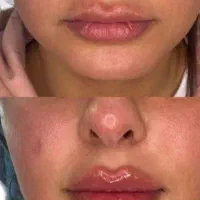 تخفیف های ویژه ژل و بوتاکس