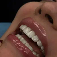 جشنواره کامپوزیت و خدمات دندانپزشکی  قیمت ویژه