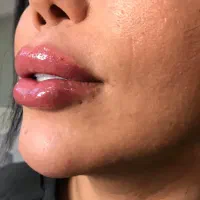 ژل/بوتاکس/مزوژل/مزوتراپی/پی ارپی و غیره