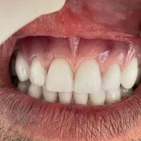 دندان مصنوعی(بدون واسطه خرید کن)|خدمات آرایشگری و زیبایی|قرچک, باقرآباد|دیوار