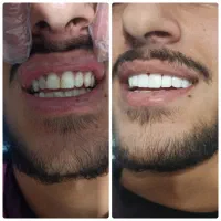 کامپوزیت دندان|خدمات آرایشگری و زیبایی|کوهدشت, |دیوار