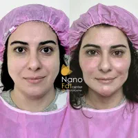 تزریق چربی صورت ماندگاری دائمی روی دست بیکینی باسن|خدمات آرایشگری و زیبایی|تهران, صادقیه|دیوار