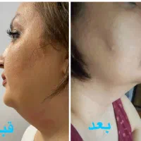 تخفیف استثنایی هایفوصورت،واژینال،کک،مک،درمان تیرگی|خدمات آرایشگری و زیبایی|تهران, هاشمی|دیوار
