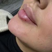 تخفیف فیلروبوتاکس مزو،درمطب پزشک|خدمات آرایشگری و زیبایی|سنندج, |دیوار