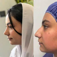 عمل جراحی بینی باجدیدترین روش روزدنیا وتخفیف۵۰درصد