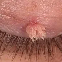 رفع دائمی و‌ریشه ای زگیل و‌تبخال