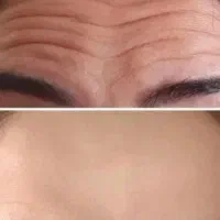 تزریق وآموزش فیلر و بوتاکس|خدمات آموزشی|فردیس, فردیس|دیوار