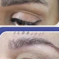 حذف تاتو و خالکوبی با لیزر کیوسوئیچ|خدمات آرایشگری و زیبایی|محمدشهر, محمدشهر|دیوار