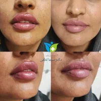 تزریق ژل بوتاکس جوانسازی پی آر پی کربوکسی و لاغری|خدمات آرایشگری و زیبایی|قزوین, |دیوار