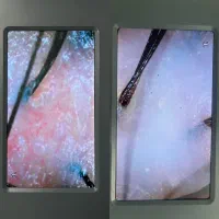 اسکالپ(درمان ریزش مو شوره مو خارش قارچ کف سر)