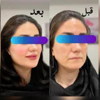 آف ویژه تزریق ژل و بوتاکس|خدمات آرایشگری و زیبایی|یاسوج, |دیوار