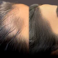 پرپشت شدن موها بدون جراحی اسکالپ حرفهای