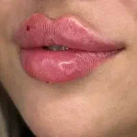 تزریق ژل و بوتاکس دکترپاک منش
