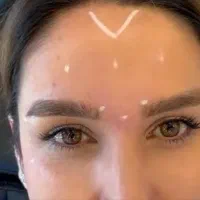 تزریق بوتاکس. زیر نظر پزشک توسط کادر درمان