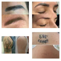 برداشتن خال وزگیل جوانسازی پاک کردن تاتو صورت وبدن|خدمات زیبایی و سلامت|کرمانشاه, |دیوار