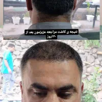 کاشت مو ابرو لیزر ژل بوتاکس مزو واکسن زگیل تناسلی