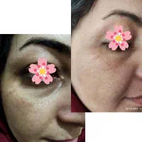 پکیج ضدلک بیست کارایی همزمان