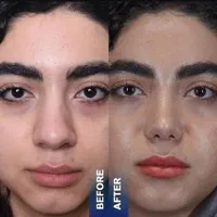 کامپوزیت لمینت بلچینگ روکش بلفارو غبغب لیفت صورت|خدمات آرایشگری و زیبایی|مشهد, فردوسی|دیوار