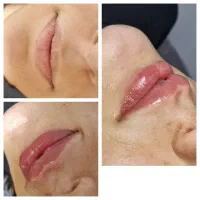تخفیف/تزریق ژللب تضمینی/فیلر/بوتاکس/فیلربادی