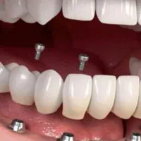 دندانپزشکی اقساطی(ارتودنسی بدون پول پیش)دندان|خدمات آرایشگری و زیبایی|مشهد, وکیل‌آباد|دیوار