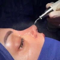 رینوپلاستی عمل بینی با متد جدید