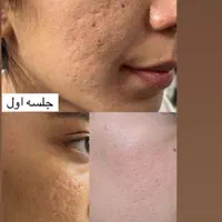 فیشیال تخصصی و درمانی فقط تا۹شهریور تخفیف داره|خدمات آرایشگری و زیبایی|مشهد, هنرستان|دیوار