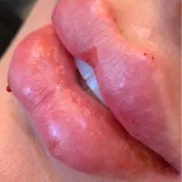 آموزش تحصصی ژل و بوتاکس وفیلر بادی