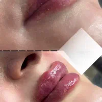 آموزش تزریق فیلر با مدل زنده + مدرک + پشتیبانی