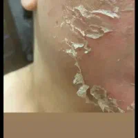 اموزش پلکسر و الگاپیل وپیریسینگ