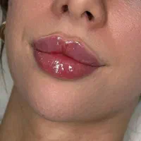 تزریق ژل لب بوتاکس لیفت نخ آنزیم کانتورینگ ساکشن|خدمات آرایشگری و زیبایی|تهران, صادقیه|دیوار
