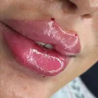 پی آرپی مزوتراپی لاغری طب سوزنی هایفو امبدینگ