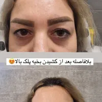 عمل زیبایی گوش (اتو پلاستی)وپلک (بلفاروپلاستی)|خدمات آرایشگری و زیبایی|شیراز, فرهنگ شهر|دیوار