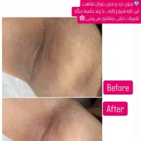 روشن سازی با لیزر پیکوشور و پاک کردن تتو|خدمات آرایشگری و زیبایی|هندیجان, |دیوار