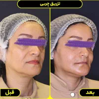 تخفیف ژل و بوتاکس و مزوتراپی و تزریق چربی|خدمات آرایشگری و زیبایی|صدرا-فارس, فاز ۱|دیوار