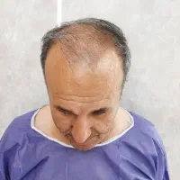 کاشت مو اولیایی