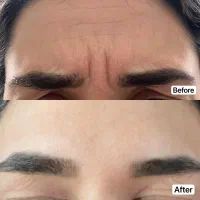 تخفیف ویژه بوتاکس فقط دونفر اول فقط تا اخرهفته