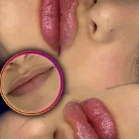 تخفیف محرم ژل 700تومن ،آموزش ژل و بوتاکس مزو۱۰تومن