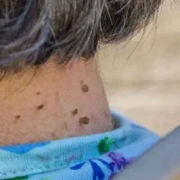 برداشتن انواع خال و خال گوشتی و منگوله یا اسکین تگ